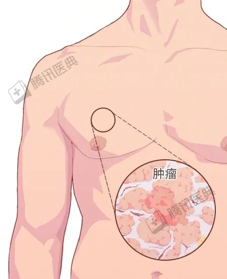 男人很容易忽視的一種癌，確診大多是晚期