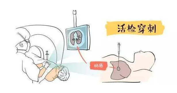 穿刺活檢是否會引起腫瘤細胞的擴散轉(zhuǎn)移？