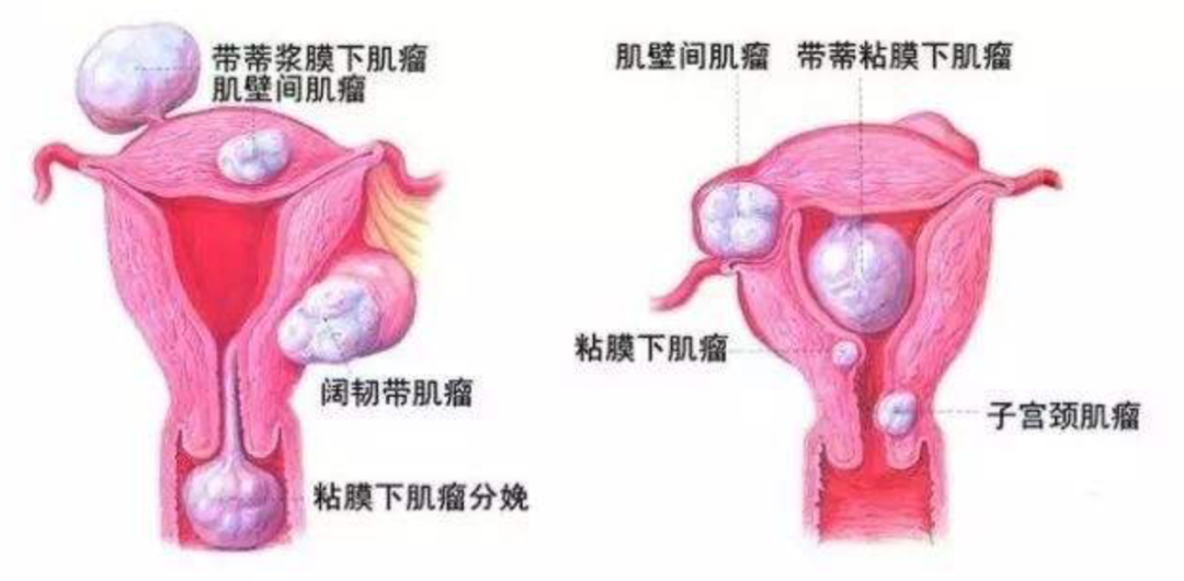 子宮肌瘤不開(kāi)刀的治療方式——子宮動(dòng)脈栓塞術(shù)