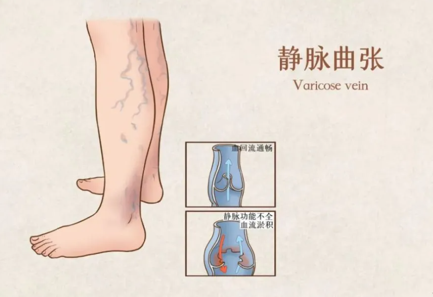 靜脈曲張不用開(kāi)刀，介入治療也能輕松處理