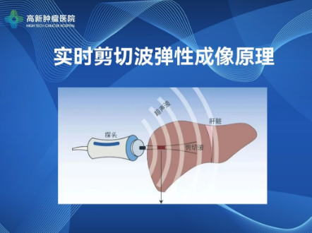 【高新喜報】我院開展肝臟實時剪切波彈性成像檢查技術(shù)，肝纖維化、肝硬化可以無創(chuàng)診斷啦！