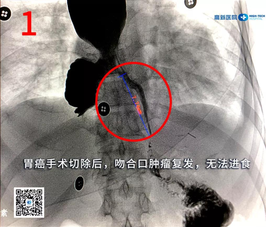 【胃癌】一位胃癌晚期患者從命懸一線(xiàn)到正常生活，幸運(yùn)絕非偶然！